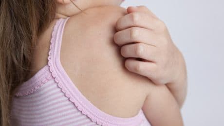 Tipps für den Sommer: Helfen Hitzestifte gegen Mückenstiche?