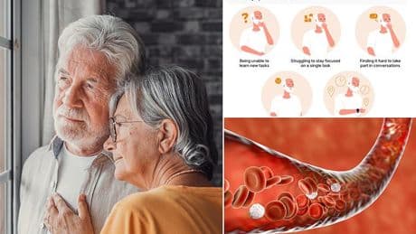Experts discover Covid triggers condition linked to dementia - and one group is most at risk