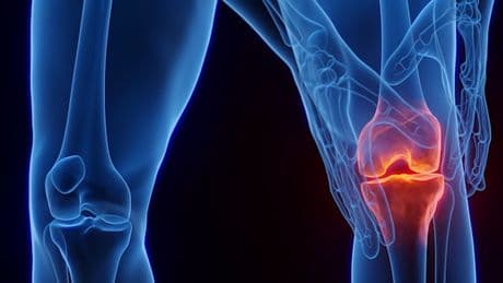 Bei Knie-Arthrose kann ein anderer Gang die Schmerzen spürbar lindern