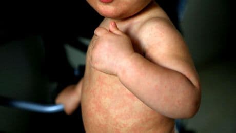 Measles cases in Glasgow's Govanhill prompt more vaccination clinics
