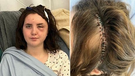 I was diagnosed with a brain tumour after doctors dismissed symptoms as heatstroke