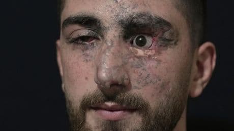 PHOTO ESSAY: Portraits of survivors of Israel's pager attack on Hezbollah last year
