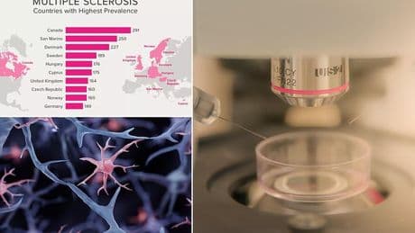 Breakthrough in fight against nerve disease that's rising in under 50s, hope for new treatment