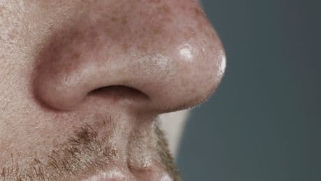 Nasenpolypen: Ursachen und Behandlung