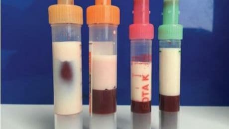 La segunda vida de la grasa en España: una rica fuente de células madre para crear terapias avanzadas