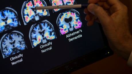 Hoffnung für Millionen Betroffene - Erster Alzheimer-Bluttest in den USA zugelassen