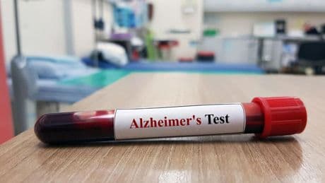 Breakthrough Alzheimer’s Blood Test Explained By Neurologists