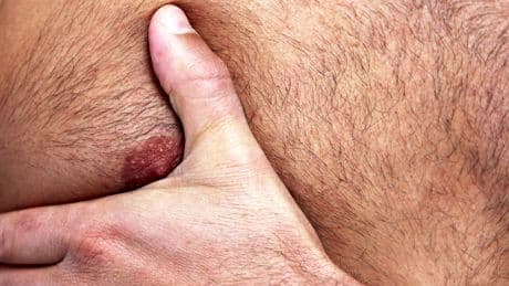 Brustwarzenschmerzen bei Männern: Diese Ursachen sollten Sie kennen