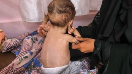 Nahost: Italien will kranke Kinder aus Gaza ausfliegen