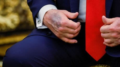Trump reveals dark bruising on hand as he goes cover-up-free in Oval Office amid health concerns
