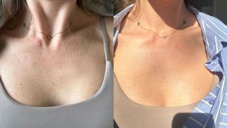 'I used retinol on my chest for a week and the change to my sun damage was incredible'