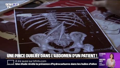 Marseille: une pince chirurgicale de 20 centimètres a été oubliée dans l'abdomen d'un patient
