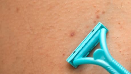 Follikulitis: Symptome, Auslöser und Behandlung
