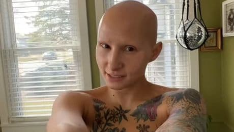 'I went bald and decided to have my breasts removed - people ask the rudest questions'