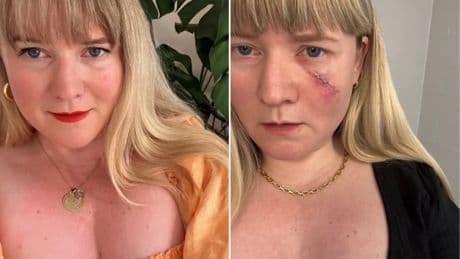 I ignored the signs of skin cancer for years – please don’t make my mistake