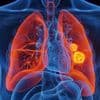 Cancer : une nouvelle molécule pour lutter contre les métastases résistantes aux traitements