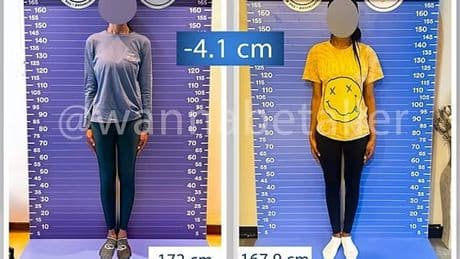 Women are flying to Turkey for brutal LEG SHORTENING operations to make themselves more petite