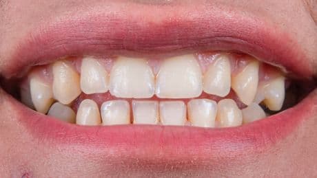 Semaglutide Users Are Reporting 'Ozempic Teeth' – But It May Not Be What They Think