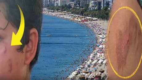 Denize giren yanıklarla çıkıyor: Tatilcilere kötü haber!