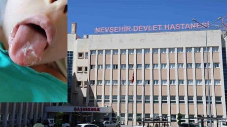 Hastanede akılalmaz ihmal! Ameliyat sırasında 5 yaşındaki çocuğun dili ve dudağı yandı