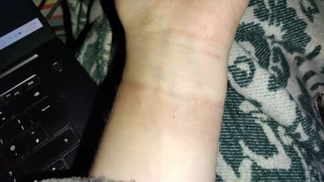 So THAT's Why The Skin Under Your Fitness Tracker Is So Red And Itchy