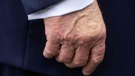 Seltsamer Fleck an Trumps Hand sorgt für Spekulationen – Weißes Haus veröffentlicht Arztbefund