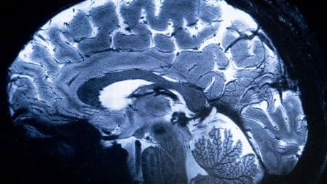 Breakthrough study finds deficiency of this common nutrient could contribute to Alzheimer’s