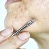Top dermatologist's urgent warning to those with spots - common remedy could leave you scarred for life