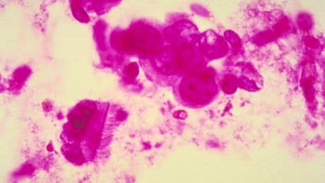 Dal “DNA Cenerentola” nuove speranze contro il cancro