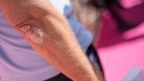 ¿Estamos cerca de alcanzar la cura de la psoriasis?