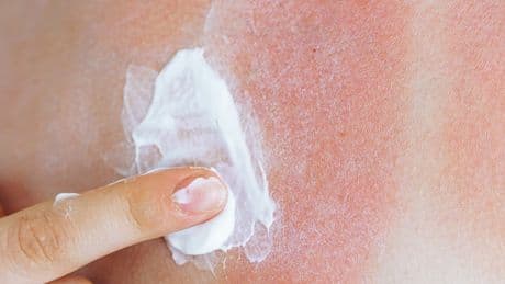 The terrifyingly few times you need to have suffered sunburn to ‘double risk of killer melanoma’ – plus 5 signs to spot