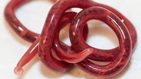 Incapable d'uriner pendant deux jours, un patient avait un ver long de 30 centimètres vivant dans ses reins
