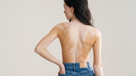 Le vitiligo, cette maladie auto-immune de la peau qui touche à l’identité