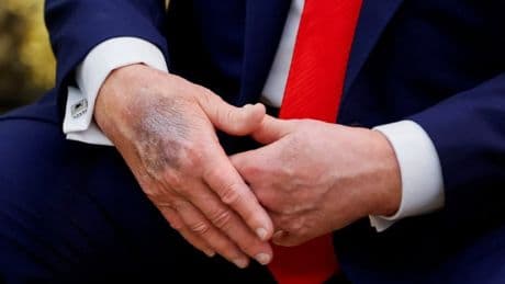 Strange bruising revealed on Donald Trump’s hand as he claims the US ‘likes a dictator’