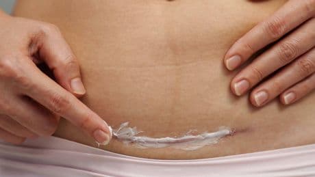 Las mejores cremas cicatrizantes para heridas y quemaduras