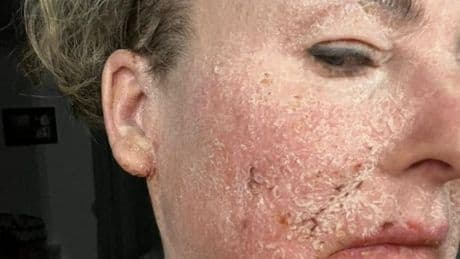 'Eczema treatment left me housebound for years - stopping it made it even worse'