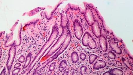 Las infecciones por 'Helicobacter pylori' podrían desencadenar más de 11 millones de casos de cáncer gástrico en el mundo