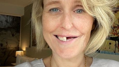 Cancer stole HALF my smile – I can feel hairs growing inside my mouth after my leg and foot were used to rebuild my face