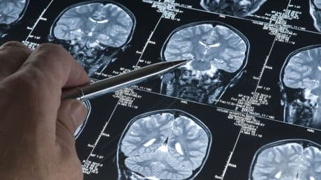 Il più piccolo neurostimolatore al mondo che rivoluziona la cura del Parkinson