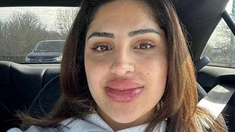 'I got lip filler dissolved - my lips were left looking minutes from exploding'