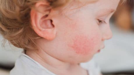 Babies' horrifying 'blistering skin' from parents applying bronzer and lip gloss