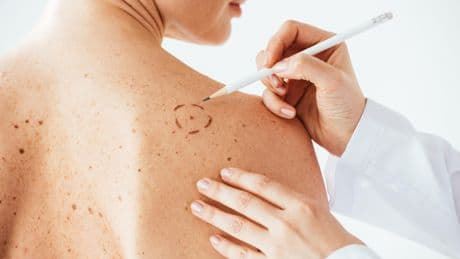 Les œstrogènes peuvent aggraver des cancers jusqu’ici considérés comme non liés aux hormones