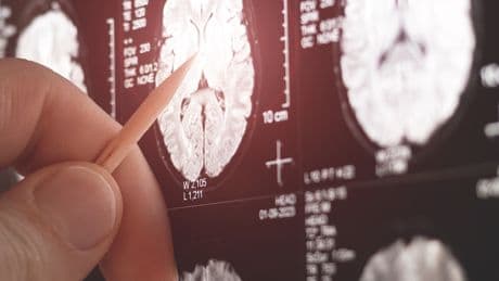 Parkinson'u tespit eden kalem üretildi
