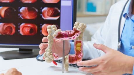 Scientists celebrate bowel cancer breakthrough in bid to tackle surge in young people
