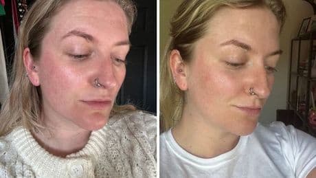 'I used the Silk'n LED mask with tightening EMS for 6 weeks - my redness and texture vanished'