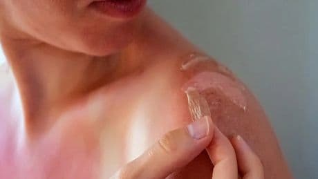 Güneş yanığı oldunuz peki şimdi ne olacak? Cilt soyulmalarını en aza indiren yöntem…