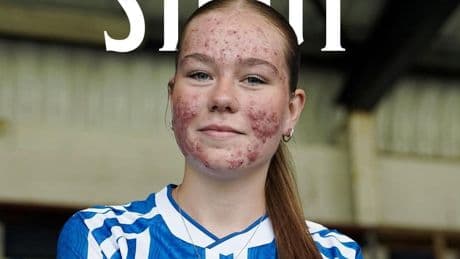 Wegen Akne angefeindet - So antwortet Fußball-Talent auf Hass-Kommentare