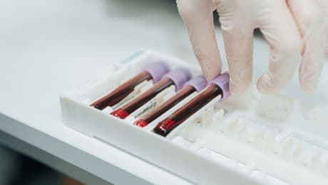 Cancer: des chercheurs détectent des tumeurs trois ans avant le diagnostic officiel grâce à un test sanguin