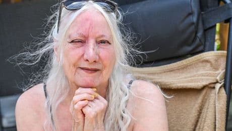 'I was left disfigured after 15-minute nap in my garden'