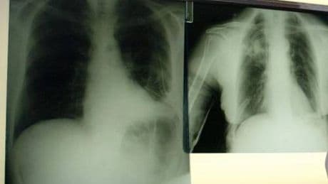 Cancro polmone a piccole cellule, ok Ue a tislelizumab
